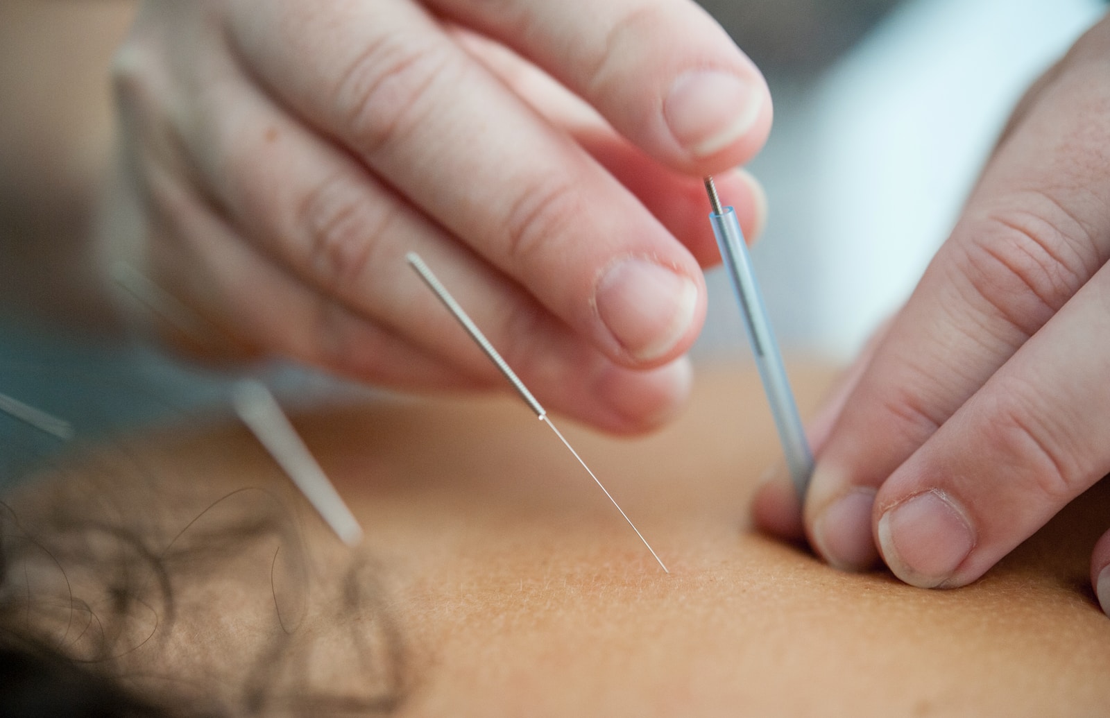Acupuncture Acupuncture